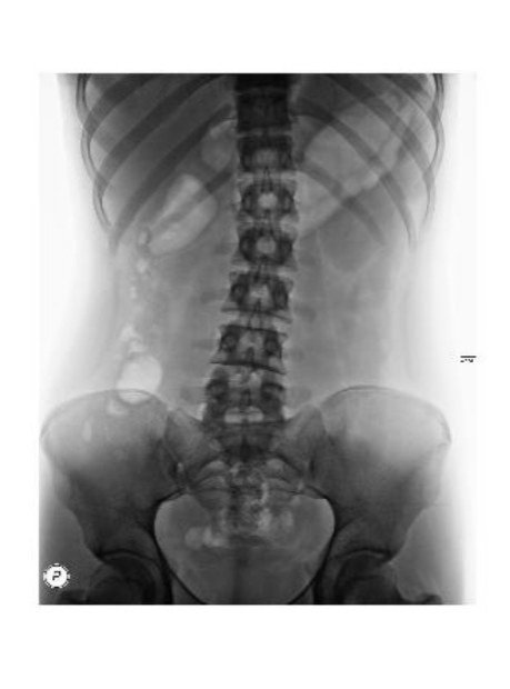 Ghidaa_Mahmood's tweet photo. Image processing with MATLAP for X-ray Spain image to enhance it #DIP https://t.co/ygaeog1PoM