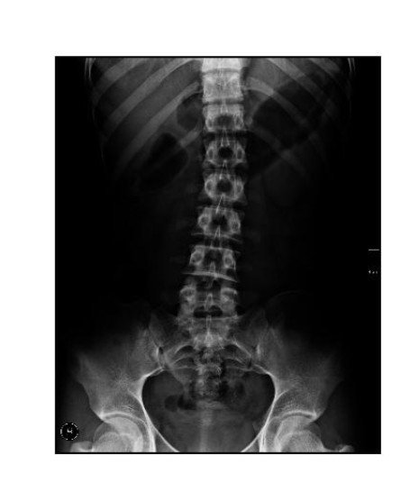 Ghidaa_Mahmood's tweet photo. Image processing with MATLAP for X-ray Spain image to enhance it #DIP https://t.co/ygaeog1PoM