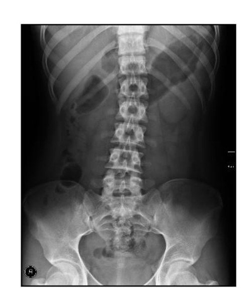 Ghidaa_Mahmood's tweet photo. Image processing with MATLAP for X-ray Spain image to enhance it #DIP https://t.co/ygaeog1PoM