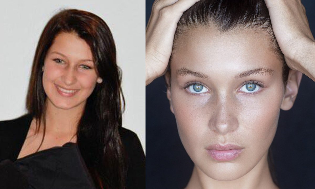 Bella Hadid before and after the plastic surgery #nose #lips #VictimOfCeleb...