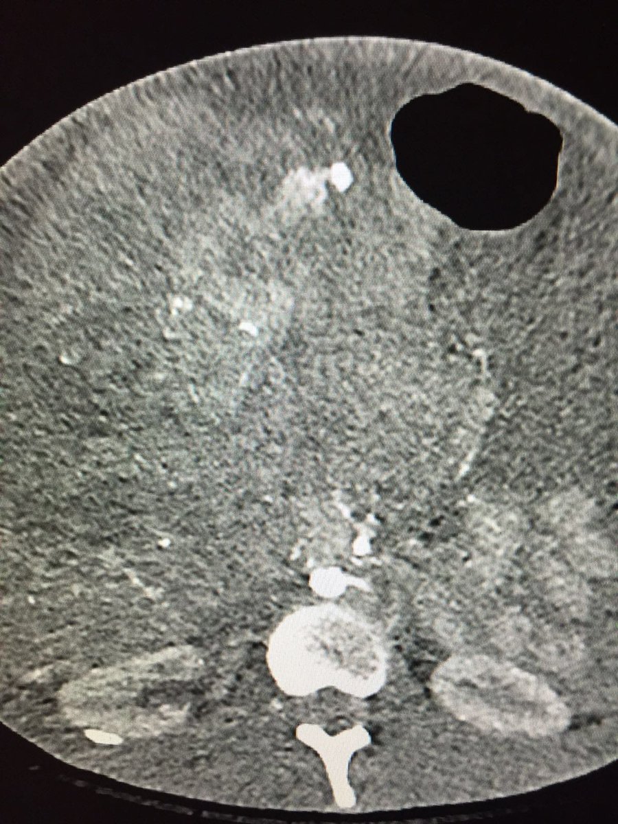 MountSinaiIR's tweet photo. Live @MountSinaiNYC #IRad: glue #embolization of ruptured HCC in 19y/o @RSP516 #justglueit #FOAMIR https://t.co/kN2cWFkJz3