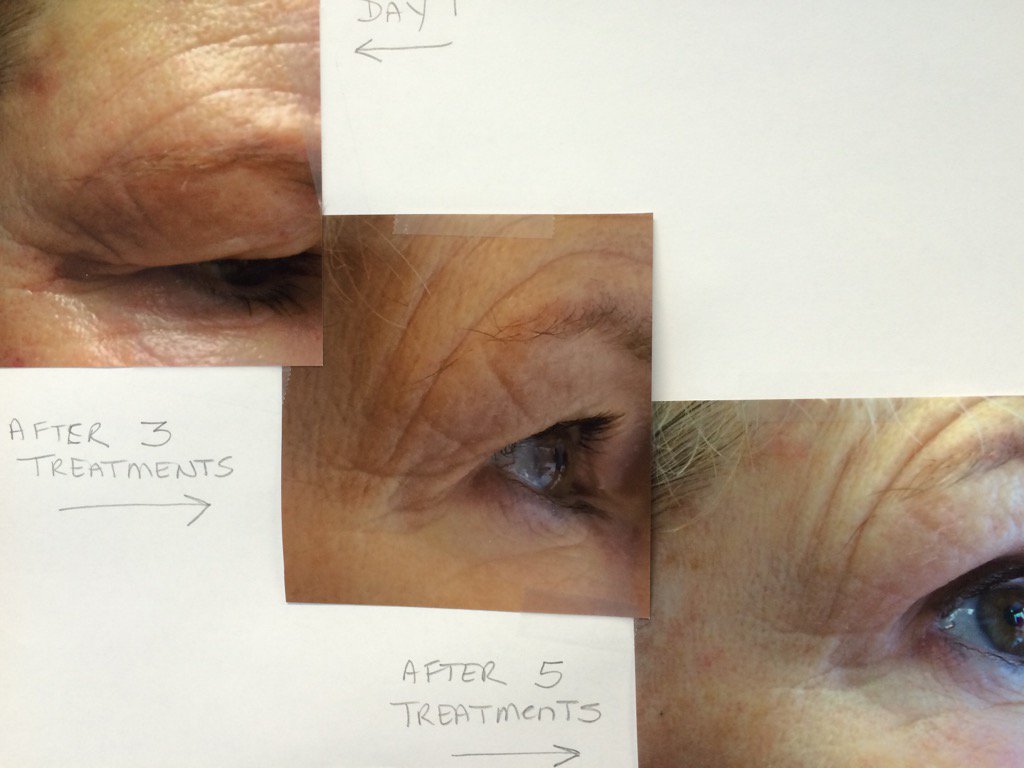 Facial Rejuvenation Cupping. No pain No fillers No needles No recovery  Facelift. FREE DEMO TONIGHT  6 pm. RSVP.