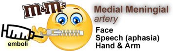 imindmaps's tweet image. Medial Meningeal artery is most frequently affected artery by emboli. Affects face, speech, hand, arm. #USMLE #meded