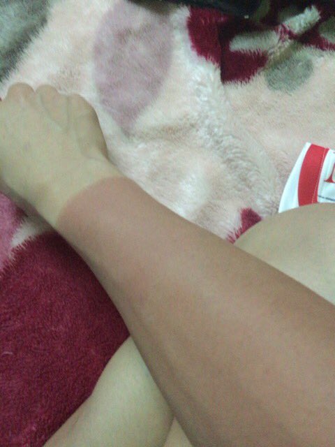 Miho Yoshikawa 今日一日 腕だけ日焼け止めを塗り忘れた所 えらいこっちゃになりました 日焼け止め大事 Wako S Aggressivedesign 日焼け止め 火傷状態 T Co 6eit975sua