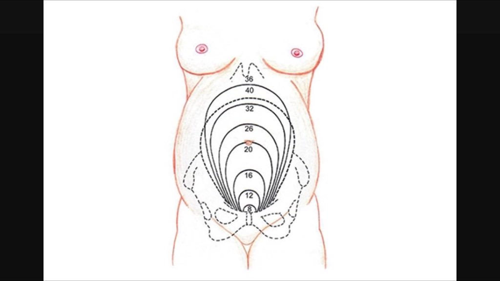 upmcem's tweet photo. Indications to Perform PMCS: within 4-5 mins of maternal arrest beyond 20-24 weeks.  #emconf @PittEMSDocs https://t.co/Yh2K005FFu