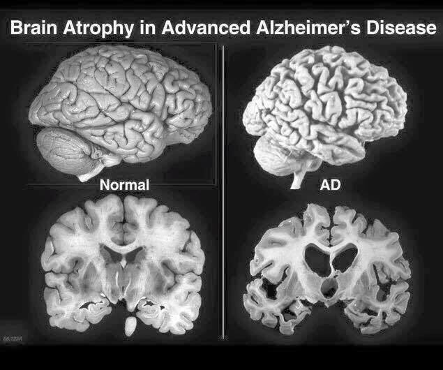 kacypleasants's tweet image. Dr.Hyman

&apos;Blood sugar that is even at a high normal can lead to Brain atrophy.&apos; #askmeaboutplexus