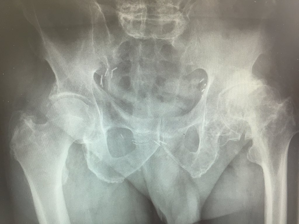 traumarioja's tweet photo. Prótesis total en displasia de cadera izquierda.Observa el descenso y medializacion del centro rotación de la cabeza https://t.co/wtTTI33vaR