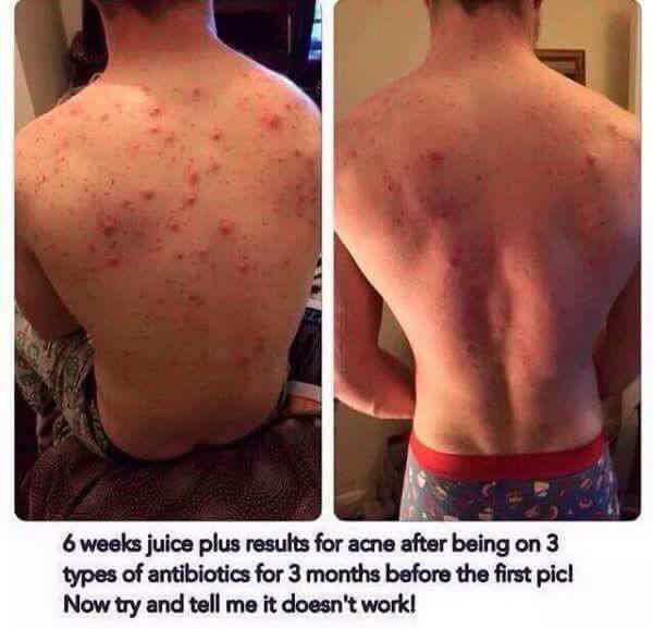 jodygribbs's tweet photo. Wow can see a massive improvement! ๐๐๐๐ #notjustweightloss #notjustwomen #mentoo #acne #capsules #nutrition https://t.co/b6tU8Q8Rx4