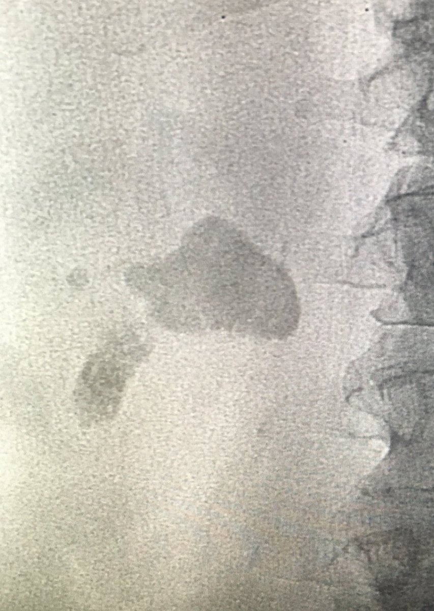 ABrandisMD's tweet photo. Back to my days of being the point guard..alley-oop to the Urologist for the jam. Yay teamwork #iRad #StoneBusters https://t.co/4h1I6rCpsO