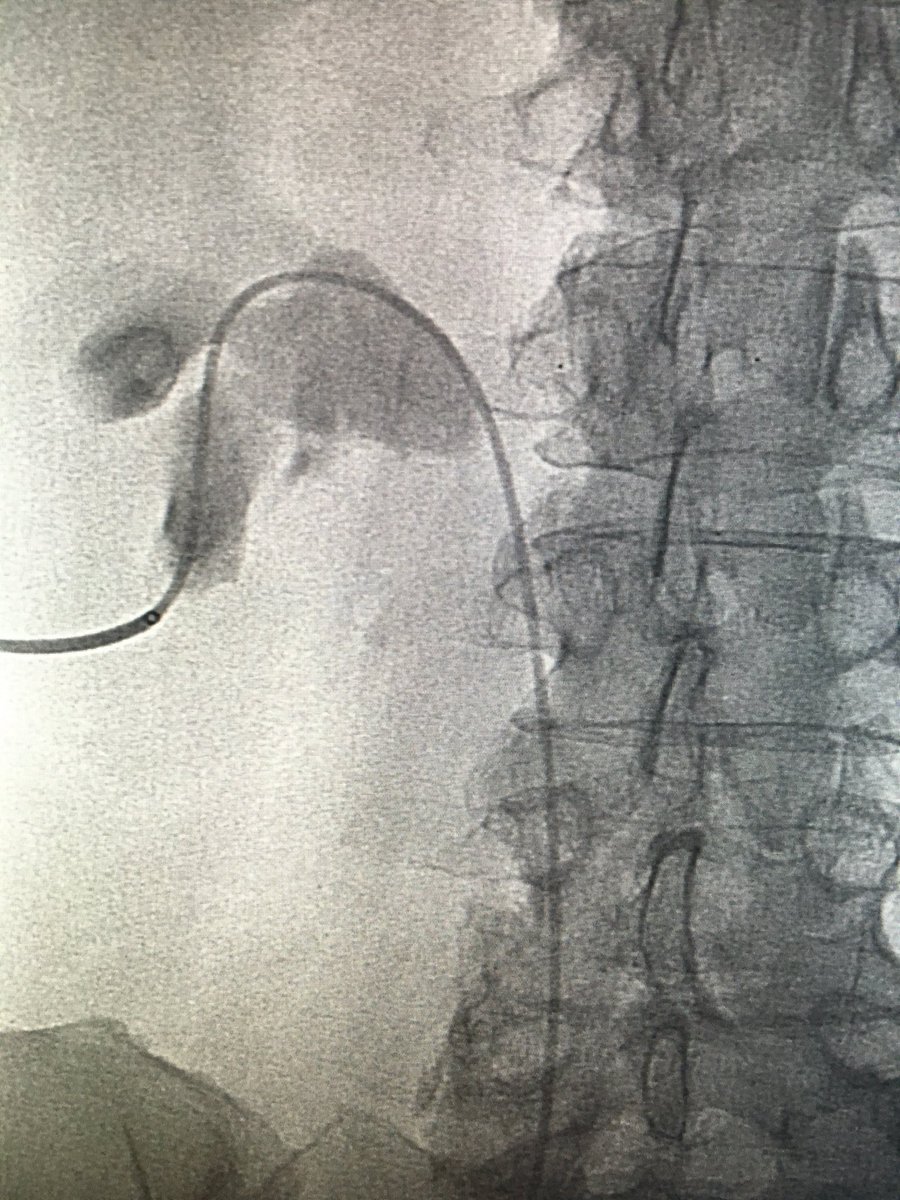 ABrandisMD's tweet photo. Back to my days of being the point guard..alley-oop to the Urologist for the jam. Yay teamwork #iRad #StoneBusters https://t.co/4h1I6rCpsO