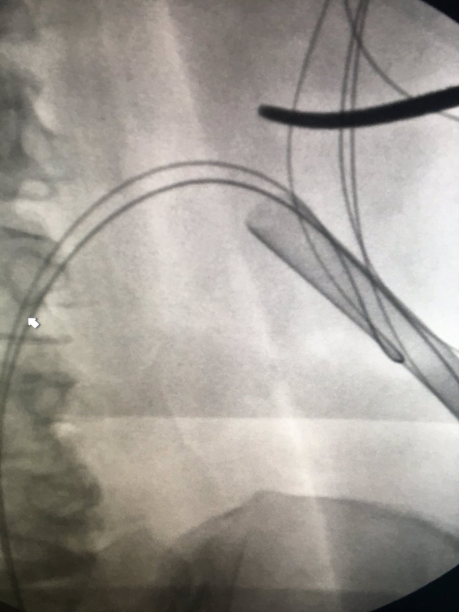 ABrandisMD's tweet photo. Back to my days of being the point guard..alley-oop to the Urologist for the jam. Yay teamwork #iRad #StoneBusters https://t.co/4h1I6rCpsO