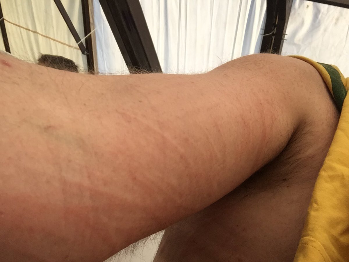 AusWinterSwim's tweet photo. @The_Ryanhorse some epic moments (and epic welts) from Freestyle day at #wswc2016 https://t.co/qBUJ0dS3rH