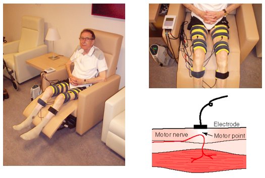 Neuromuscular Electrical Stimulation