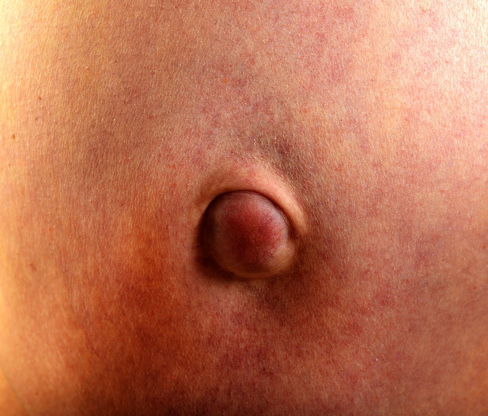 pazienti's tweet image. Un fastidioso #rossore attorno all' #ombelico? Risponde la Dr.ssa Schmitt!  &amp;gt; bit.ly/ombelico_irrit…
