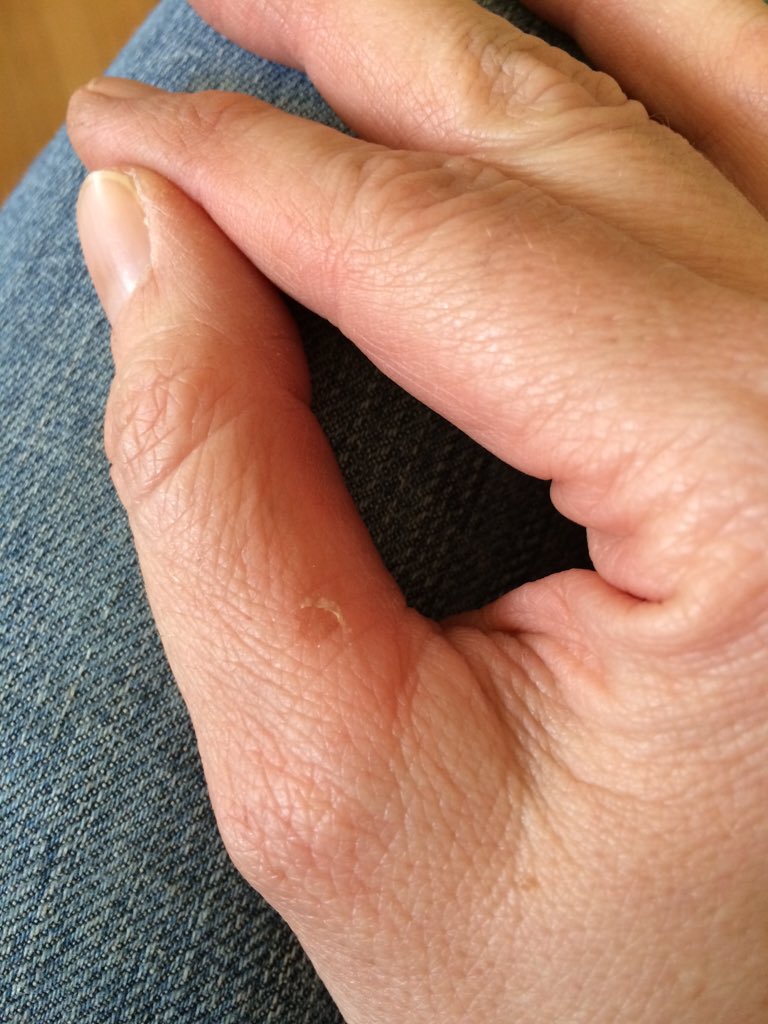 TracyMarshburn's tweet photo. Ouch!  Volunteer event today...nice blister.  #WeAreCisco https://t.co/SLdAfGcmni