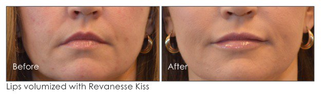 DrGuyMorum's tweet photo. We love a beautiful lip! Fuller, more youthful, symmetrical lips! #drguymorum #revanessekiss #alyria #squamish https://t.co/OISDfJTGNJ