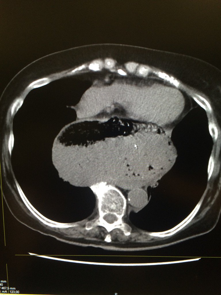 EGLS_'s tweet image. Obstructive shock / compressed heart !!caused by gastric volvulus at level of para-oesophagal hernia (intrathoracic)