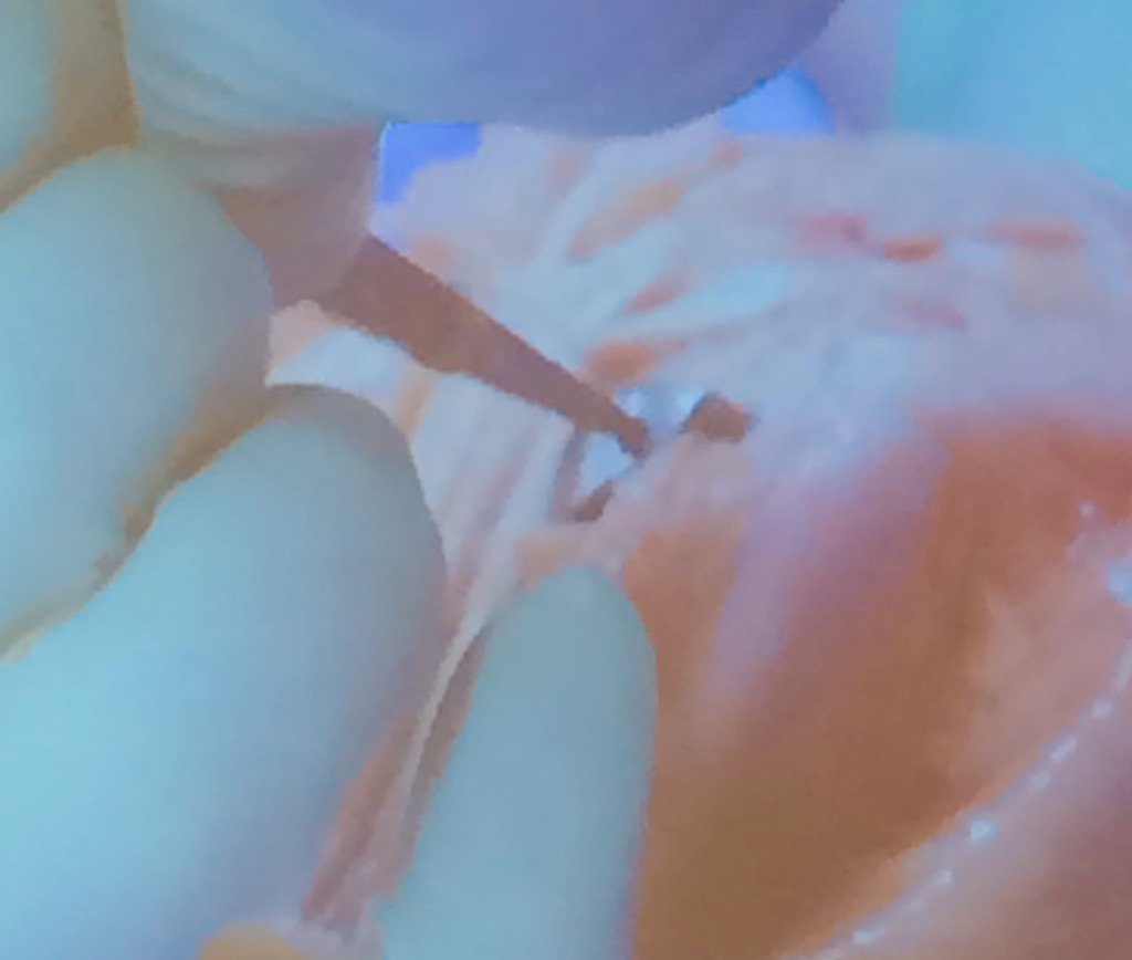 Andraleann's tweet photo. Partial ulnar head replacement part 2. Done in 8 min 30 seconds. #TSHT2016 https://t.co/7nt88EB5Pu