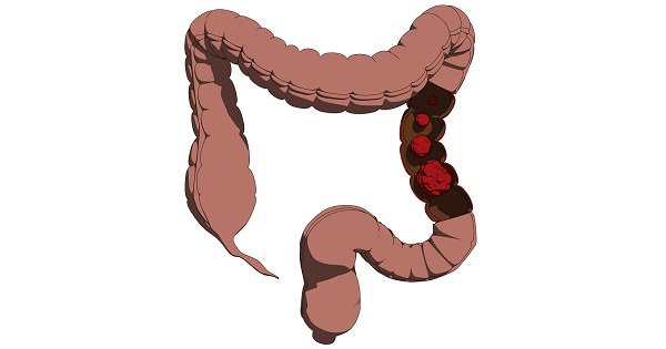 CLIKISalud1's tweet image. ¿Quieres reducir tu riesgo de #CáncerDeColon? Solo sigues estos 6 sencillos pasos. clikisalud.net/te-decimos-los…