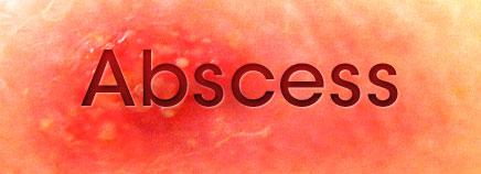 KFSHRC_Research's tweet photo. Trimethoprim–Sulfamethoxazole versus Placebo for Uncomplicated #SkinAbscess
https://t.co/8MMLlsDqSu https://t.co/wT6PWkafWL