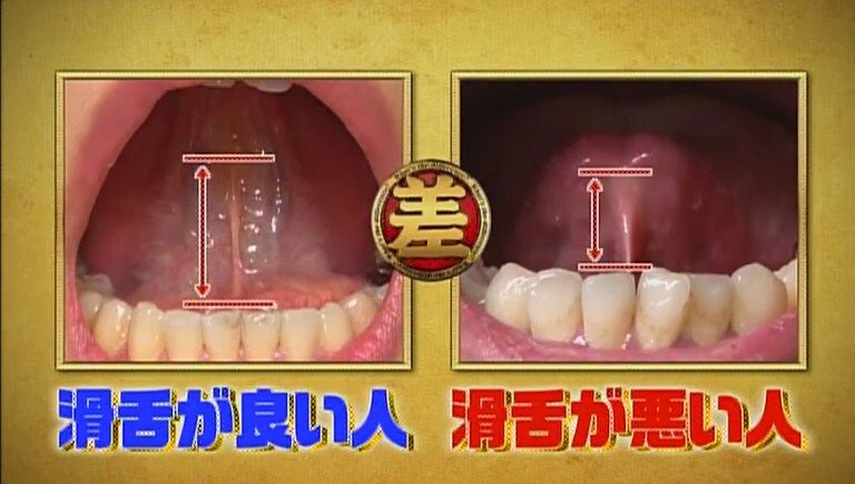 Tbsこの差って何ですか على تويتر 滑舌の良し悪しは舌小帯の長さの差にあったのサ Tbs この差 滑舌悪い 滑舌 Https T Co Ub3yz5farb