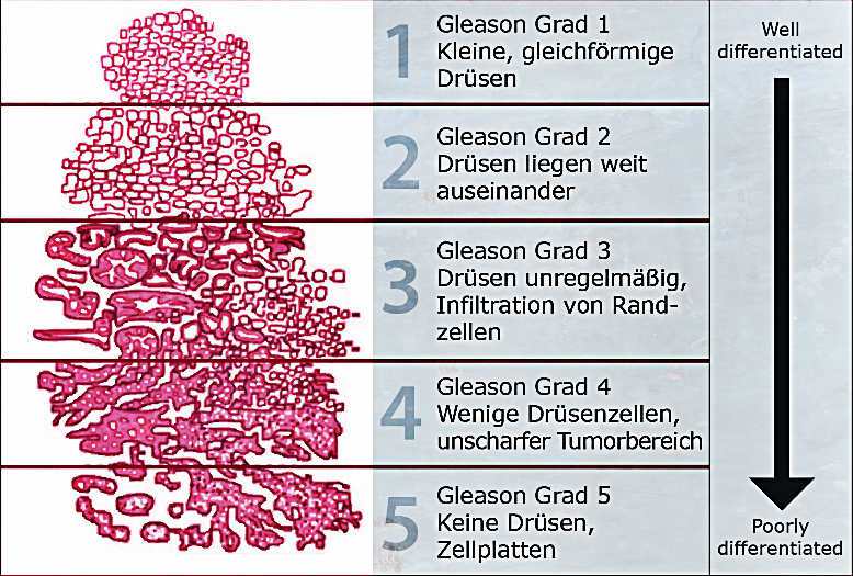 HealthCleveland's tweet photo. Prostate Cancer Gleason Score https://t.co/tkUa0fepxf https://t.co/4qUbpqxVlW