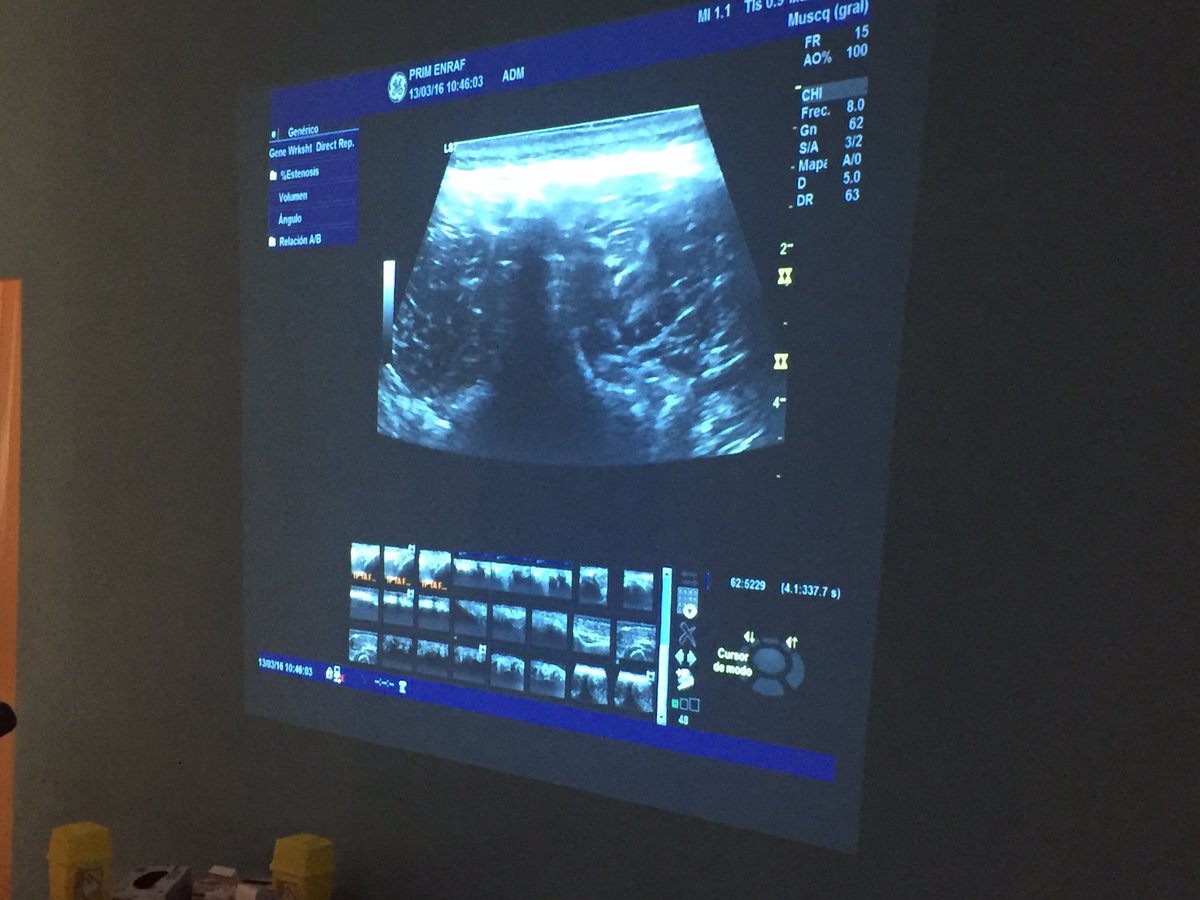 ElectrolisisP's tweet photo. Domingo completo con abordajes #electrolisispercutanea en #multifidos #cuadradolumbar #piriforme #ciatico @primfisio https://t.co/auOCYoaRq4