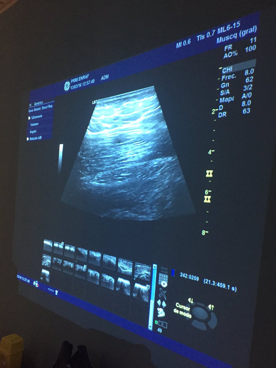 ElectrolisisP's tweet photo. Domingo completo con abordajes #electrolisispercutanea en #multifidos #cuadradolumbar #piriforme #ciatico @primfisio https://t.co/auOCYoaRq4