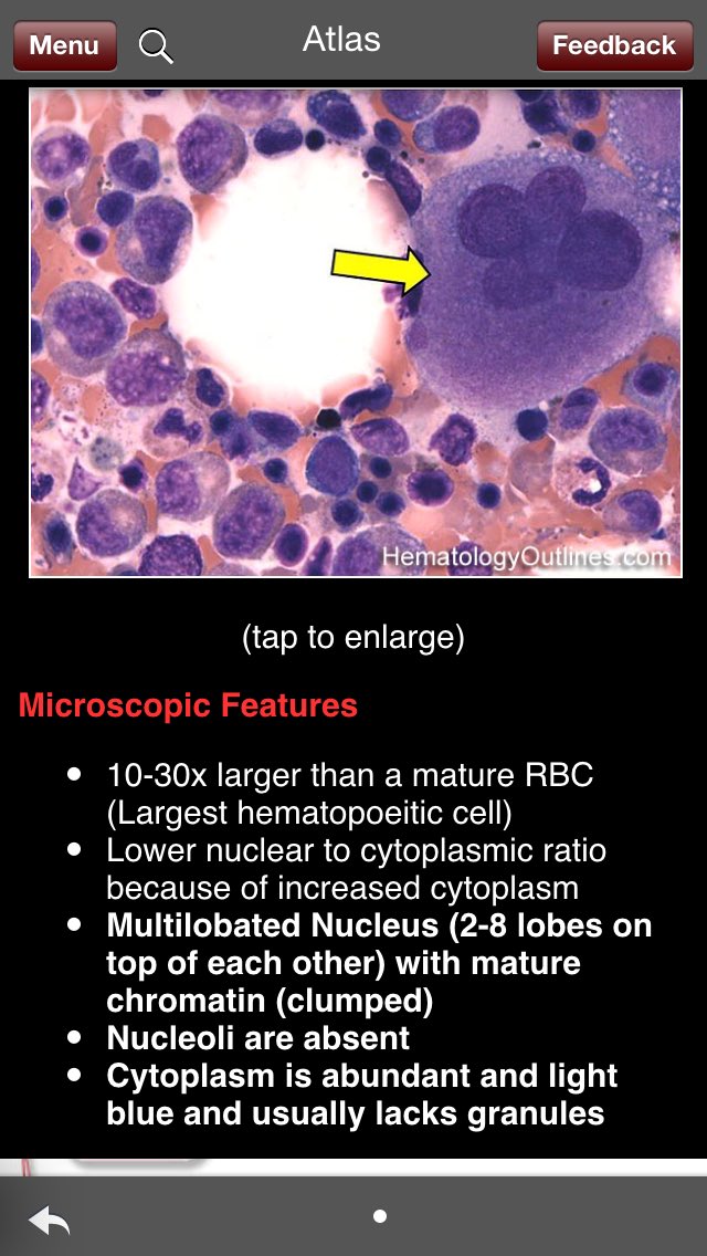 pembeoltulu's tweet photo. Megacaryocyteπ·https://t.co/bffOQiPwUN #POpath #insitupathologists #USCAP2016 #hemepath @evemariecrane @Nathan_E_Lee https://t.co/W0s3s5iMSn