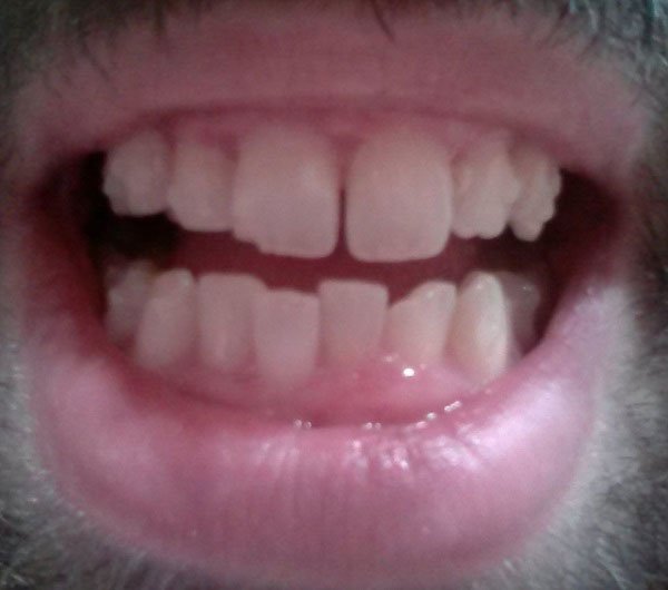 Dani_Invisalign's tweet photo. Mi experiencia:
Resultados tras 6 meses con #Invisalign - https://t.co/P47LXf3yMx https://t.co/wOzKM5G5u4