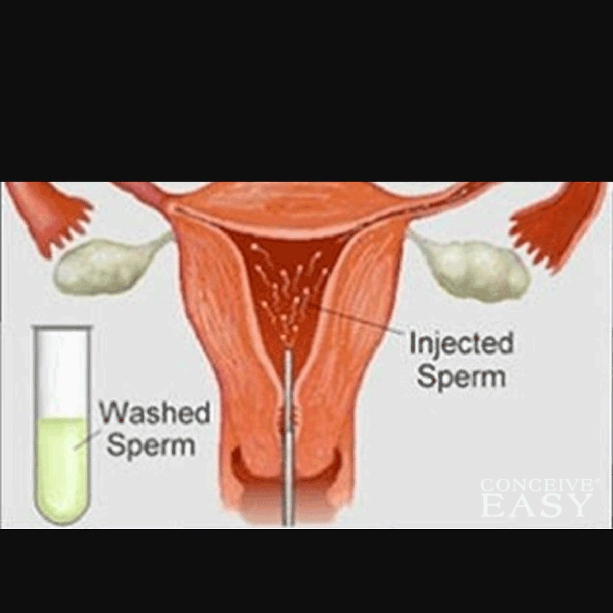 infertility_39's tweet photo. #3rdiui #iui #infertily #infertilitysucks #infertility40s #infertily30s #ttc #ttcjourney #ttccommunity https://t.co/OF5UHBLolH