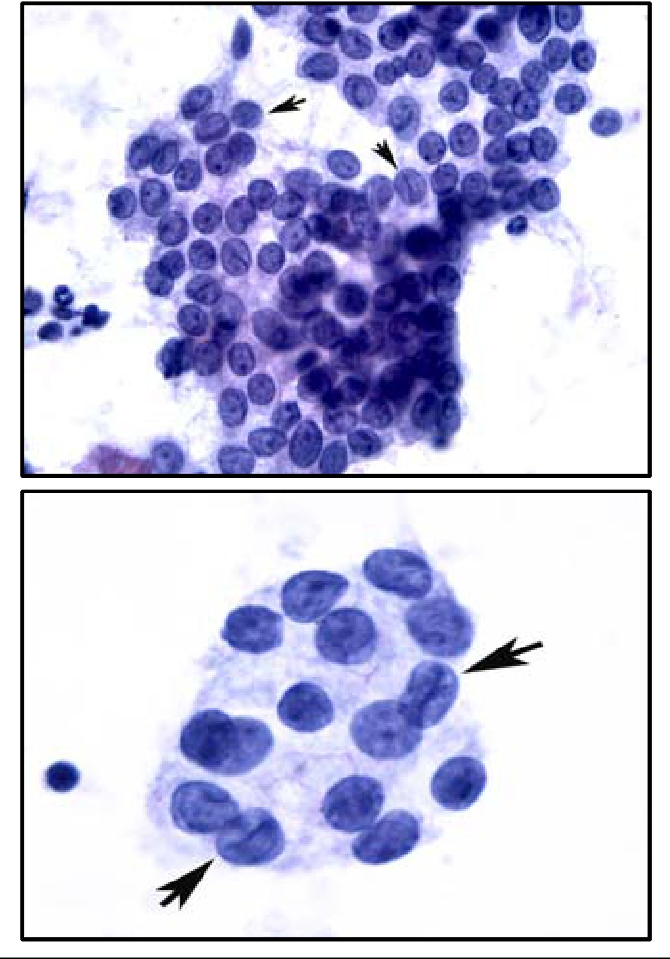 Pathology Outlines Niftp