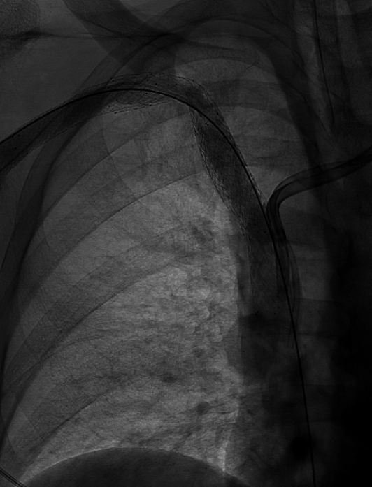 Live <a href="/MountSinaiNYC/">Mount Sinai Health System</a> #IRad: #Gunsight recan #SVC #subclavian #twosnares <a href="/MUSCVIR/">MUSC Interventional</a> <a href="/gsiskin/">Gary Siskin</a> @rkryu <a href="/amishpatelmd/">Amish Patel</a>