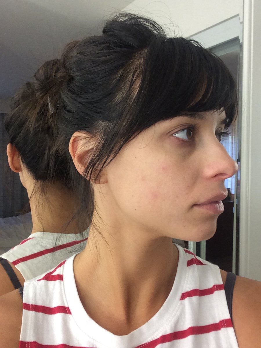 DrBreiners's tweet photo. Watch acne scars disappear. Your face will be smoother and softer in just weeks! #acne #skincare #drbreiners https://t.co/I9HAoUmjqu