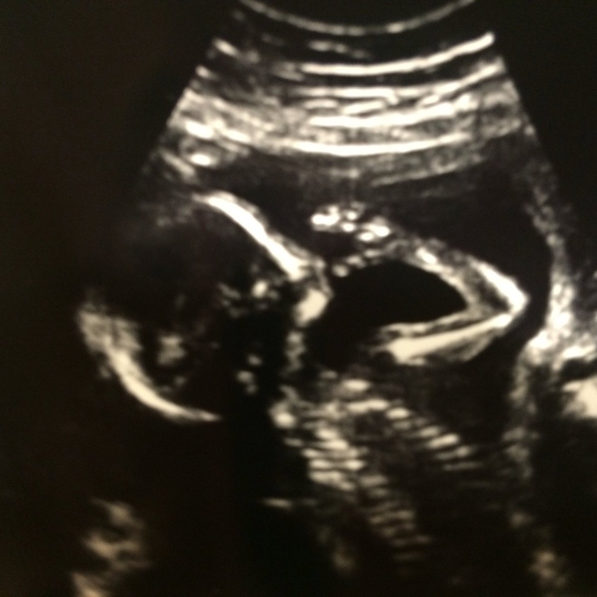 daisylove4's tweet image. My granddaughter sucking her thumb already🎀