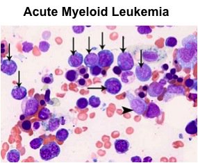 drfranktarazi's tweet image. #Celator Pharma Vyxeos improved survival in Ph 3 trial in patients with high-risk #AML! OMG! $CPXX is up &amp;gt; 350%!!