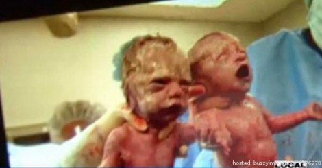 vejonuxifax's tweet photo. Giving Birth To Twins Is Very Rare, But I've Never Seen This Happen Before.See here =>> https://t.co/7tws81wEEN https://t.co/IhBZVLpopM