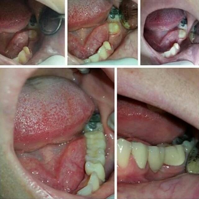 WorldSteticGye's tweet photo. Coronas de Porcelana altamente esteticas en → @WorldSteticGye ← Consulta GRATUITA☎ 6027410 @DrPeterValverde #Urdesa https://t.co/MwH2nB0dJK