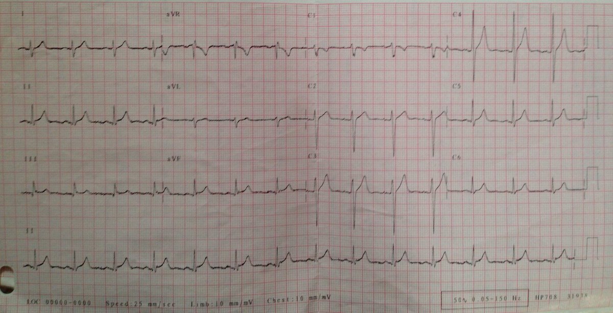 DrDavidWarriner's tweet photo. And here's my 12 lead ECG, taken in 2004, 2010 & 2014! #peaky #cardioed #lvhmuch #jpointelevation #normallyabnormal https://t.co/yK1bRS0Kvw