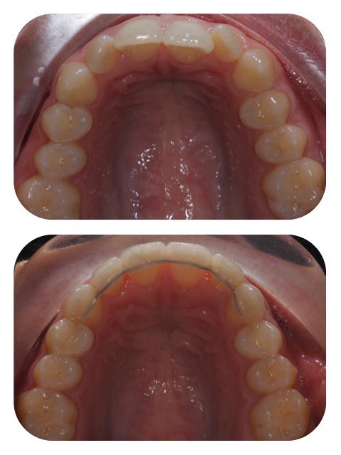 Sam_the_dentist's tweet photo. One of my recently completed @QSTuk cases. Done in 6 months, delighted with the result. #StraightTeeth #Smile https://t.co/tGJDLqFvre