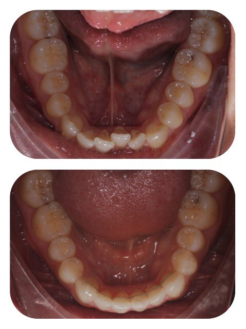 Sam_the_dentist's tweet photo. One of my recently completed @QSTuk cases. Done in 6 months, delighted with the result. #StraightTeeth #Smile https://t.co/tGJDLqFvre