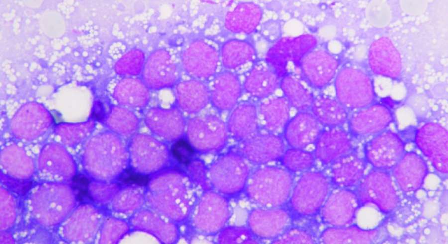 sextaNoticias's tweet photo. Crean un modelo de algoritmos capaz de predecir la leucemia https://t.co/Doz5Cp3mIX https://t.co/GMrh5cvSDg