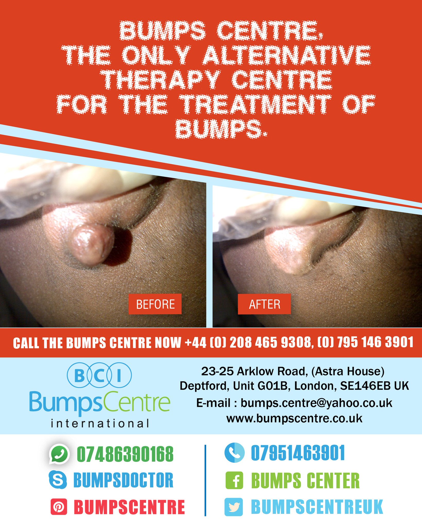 Bumps Center On Twitter Get Rid Of Your Keloid Hypertrophic