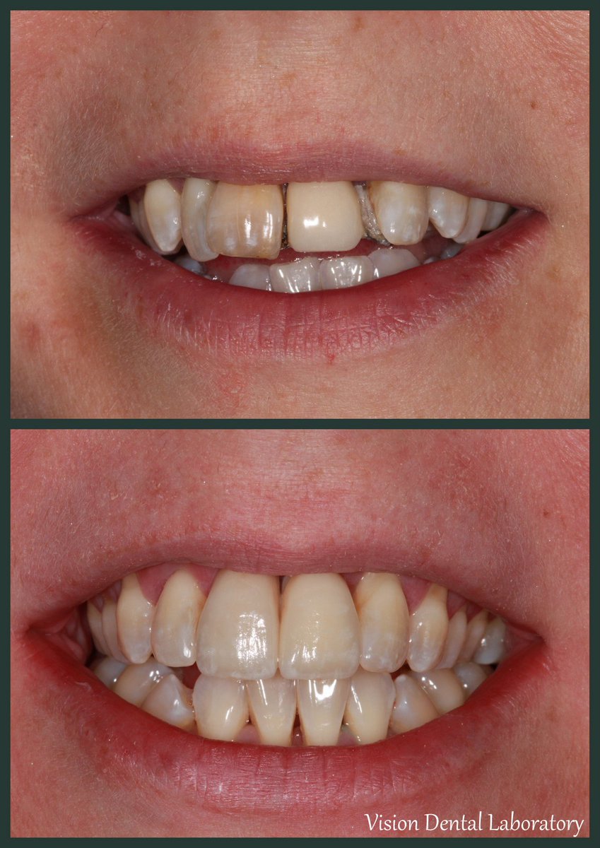 visiondentalab's tweet photo. Implant Zirconia Crown (21) and Zirconia Crown (11). https://t.co/WRMdxcUSWQ