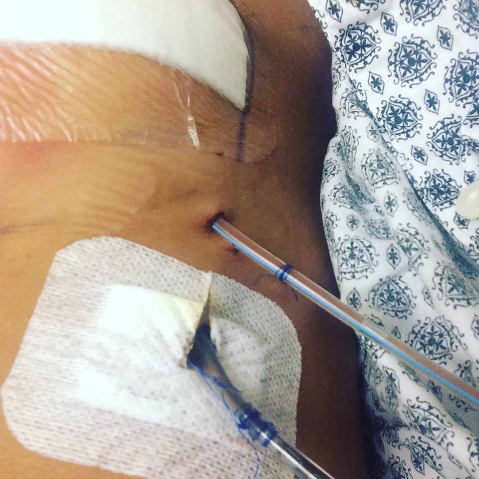 secretdiaryofcg's tweet photo. #mastectomy #doublemastectomy #breastcancer #bcsm #preventativesurgery #breastreconstruction #drains #surgery https://t.co/XZRuEyKNT1