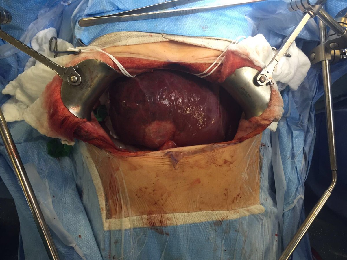 MountSinaiIR's tweet photo. Live @MountSinaiNYC #IRad : #Y90 #radiation lobectomy #HCC #intraop @AASLDNews @JHepatology @HepBFoundation https://t.co/OpZZEy3lvp