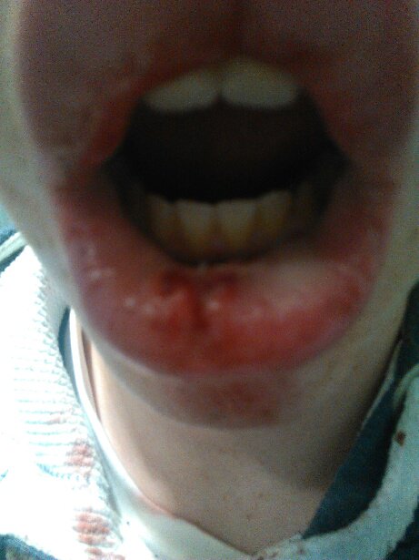 Can you guess who the latest addition to the #MLYC injury list is?
(No - He wasn't in a scrap with anybody!) #ouch