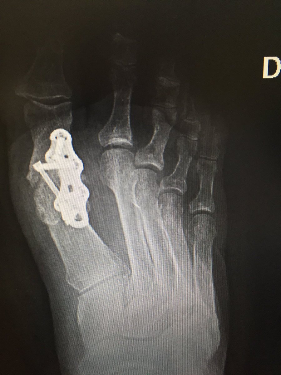 DrRamonNavarro's tweet photo. Caso clínico. Hallux #rigidus estadio IV. #artrodesis MTF con placa y tornillo a compresión.@ClinicaCEMTRO https://t.co/HwvxLASoFz
