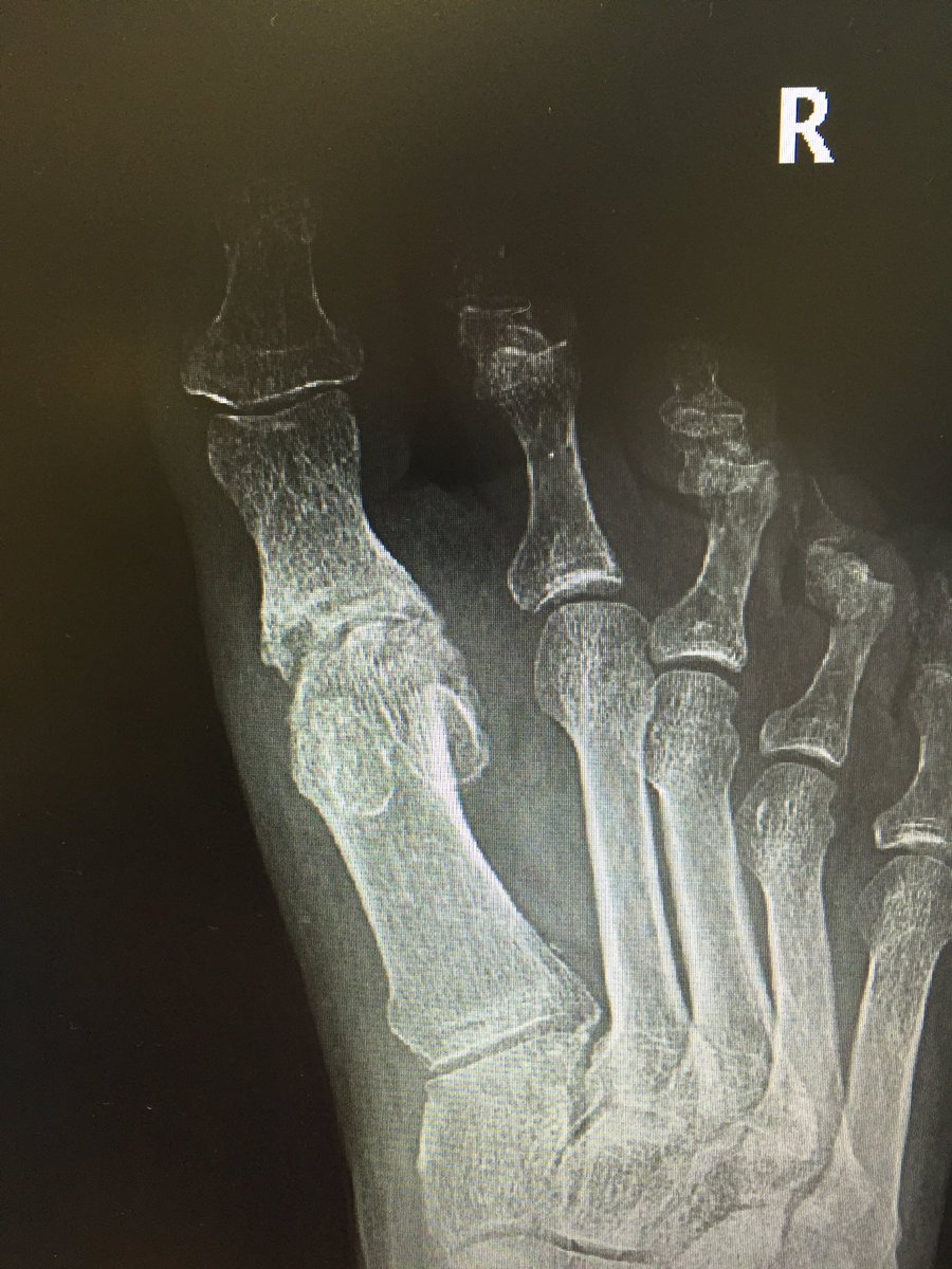 DrRamonNavarro's tweet photo. Caso clínico. Hallux #rigidus estadio IV. #artrodesis MTF con placa y tornillo a compresión.@ClinicaCEMTRO https://t.co/HwvxLASoFz