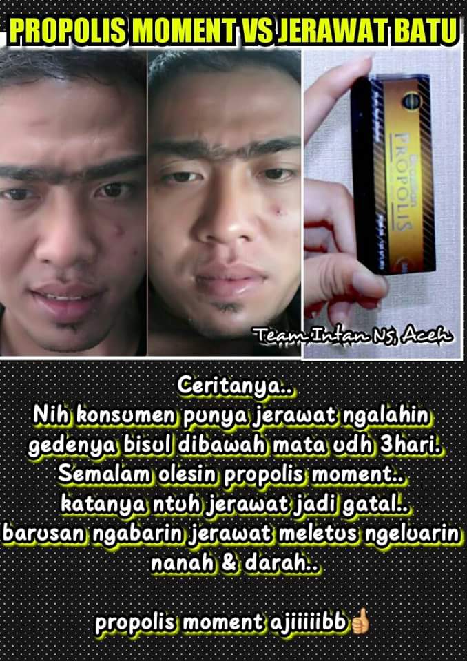 septin_viryani's tweet photo. Propolis moment bisa untuk jerawat batu juga gessss..... https://t.co/DDXBWNrYOW